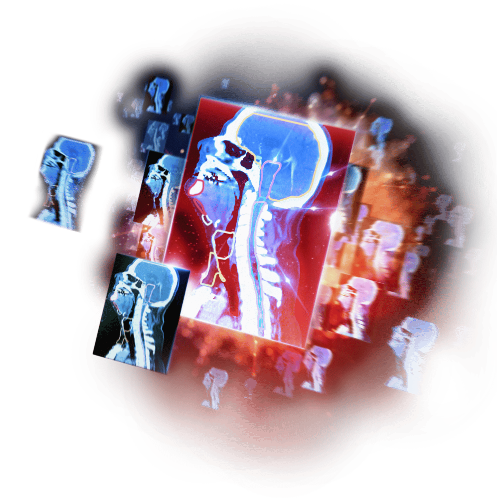 MIM SurePlan MRT | Dosimetry for MRT and Theranostics, Segmentation, DIR