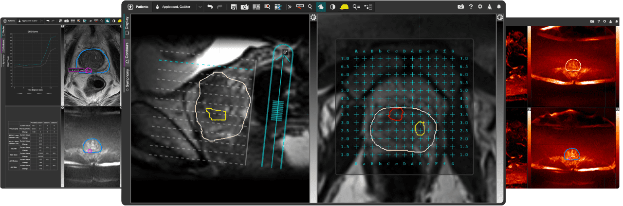Three images of medical scans with drawn contours on certain areas of the images. 